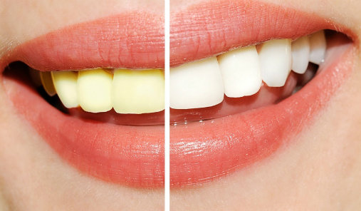5 preguntas frecuentes sobre el blanqueamiento dental