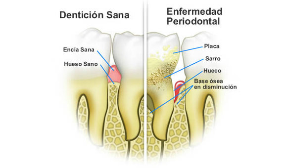 ¿Qué es la bolsa periodontal?