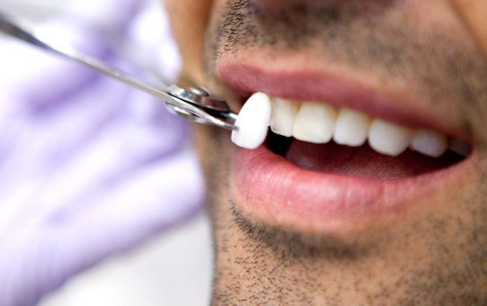 5 preguntas frecuentes sobre las carillas dentales