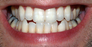 Qué es el contorneado estético dental