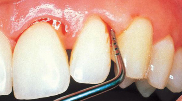 Enfermedades periodontales ¿Qué hay que saber?