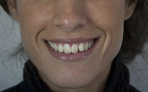 Carillas dentales y blanqueamiento dental para unos dientes más blancos