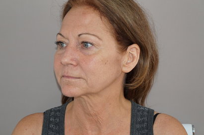 The Liquid Facelift - Vesiavusteinen kasvojenkohotus on hellävaraisempi vaihtoehto: Kuva #1